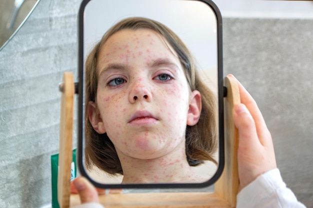 Co na trądzik dla 12 latki i jak wybrać odpowiednią pielęgnację?