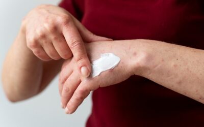 Jak objawia się uczulenie na krem?